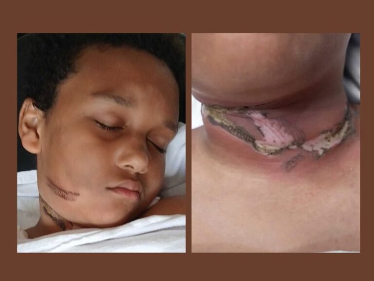 9-Year-Old Louisiana Boy Severely Burned After Necklace Got Tangled in Tablet Charger While Sleeping